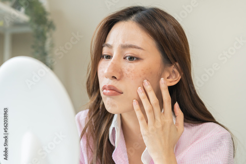 Dermatology, expression face worry, stressed asian young woman hand touching facial at dark spot of melasma, freckles from pigment melanin, allergy sun. Beauty care, skin problem treatment, skincare. photo