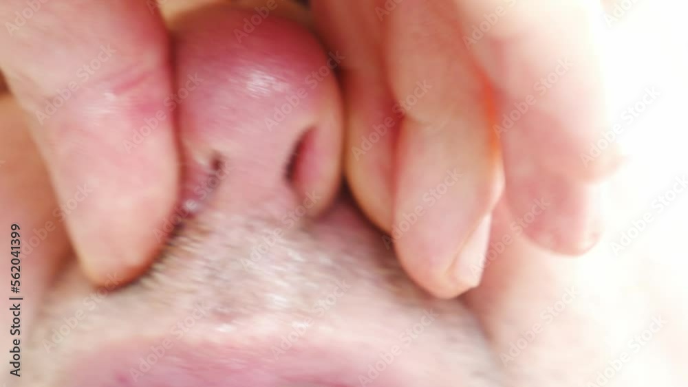 nostrils close-up. the man blows his nose. snot and mucus due to illness. the concept of seasonal SARS and influenza. nostrils close-up. the man blows his nose. snot and mucus due to illness. the concept of seasonal SARS and influenza.