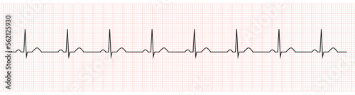 Fotografia EKG showing normal sinus rhythm of patient