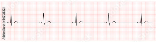 EKG Showing Sinus Bradycardia of Patient  photo