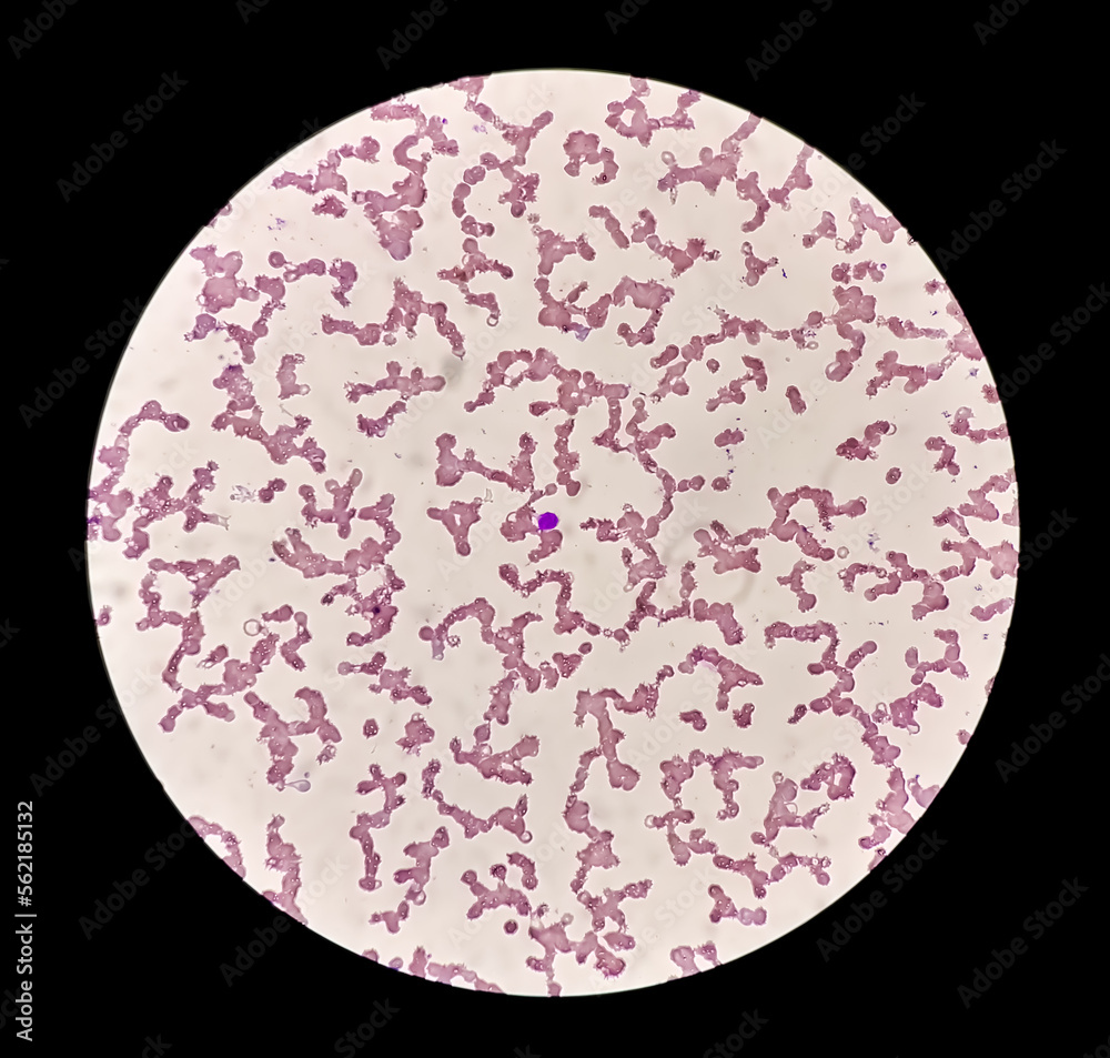 Microscopic view of hematological slide showing Pancytopenia. A ...