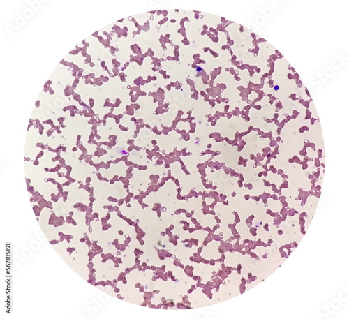 Microscopic view of hematological slide showing Pancytopenia. A condition in which there is a lower number of RBC, WBC and platelets in the blood. photo