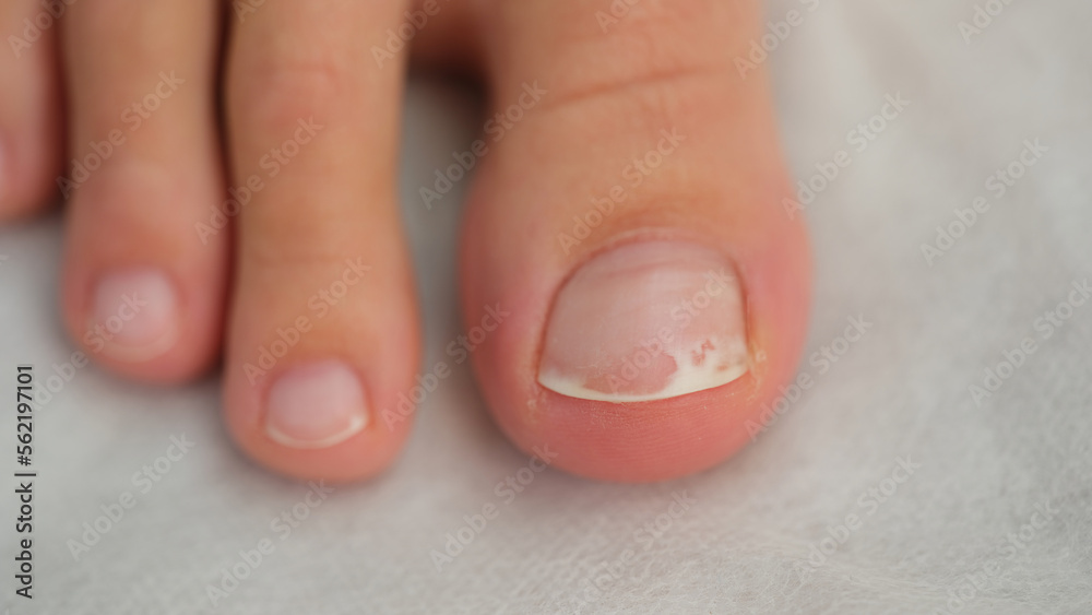 Damaged toenail close up, shallow depth of field. - obrazy, fototapety, plakaty 