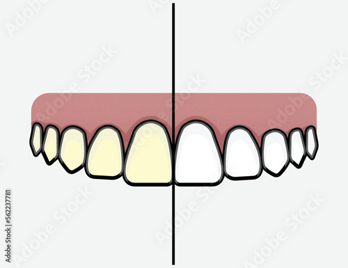 teeth whitening vector from yellow teeth to white teeth before and after vector