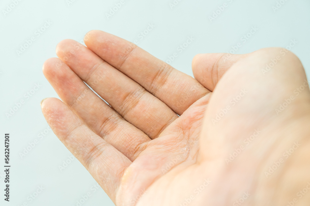 A man hand palm with dyshidrotic or pompholyx eczema illness A man hand palm with dyshidrotic or pompholyx eczema illness