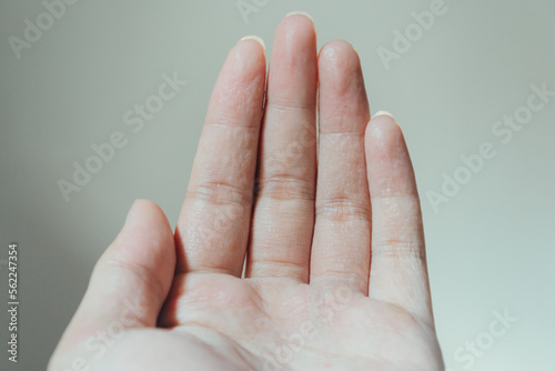 A man hand palm with dyshidrotic or pompholyx eczema illness