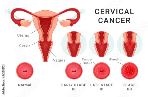 Cervical cancer stage medical healthcare educational scheme vector flat illustration