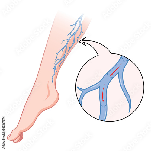 Varicose veins. Blue blood vessel visible through the skin, abnormally swollen leg. Vascular disease diagnostic and treatment. Venous insufficiency medical flat