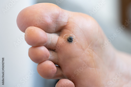 Closeup of dead skin around wart plantar after cauterizing it with celandine on infected foot. Hygiene, human skin disease, papillomavirus or HPV concept. Self-medication.  photo