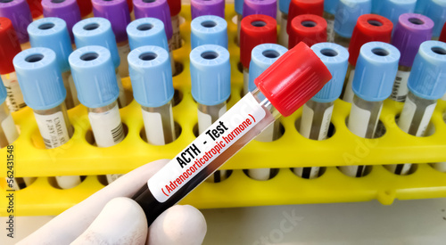 Blood sample for Adrenocorticotropic hormone (ACTH) test, diagnosis of Addison's disease with laboratory background. photo