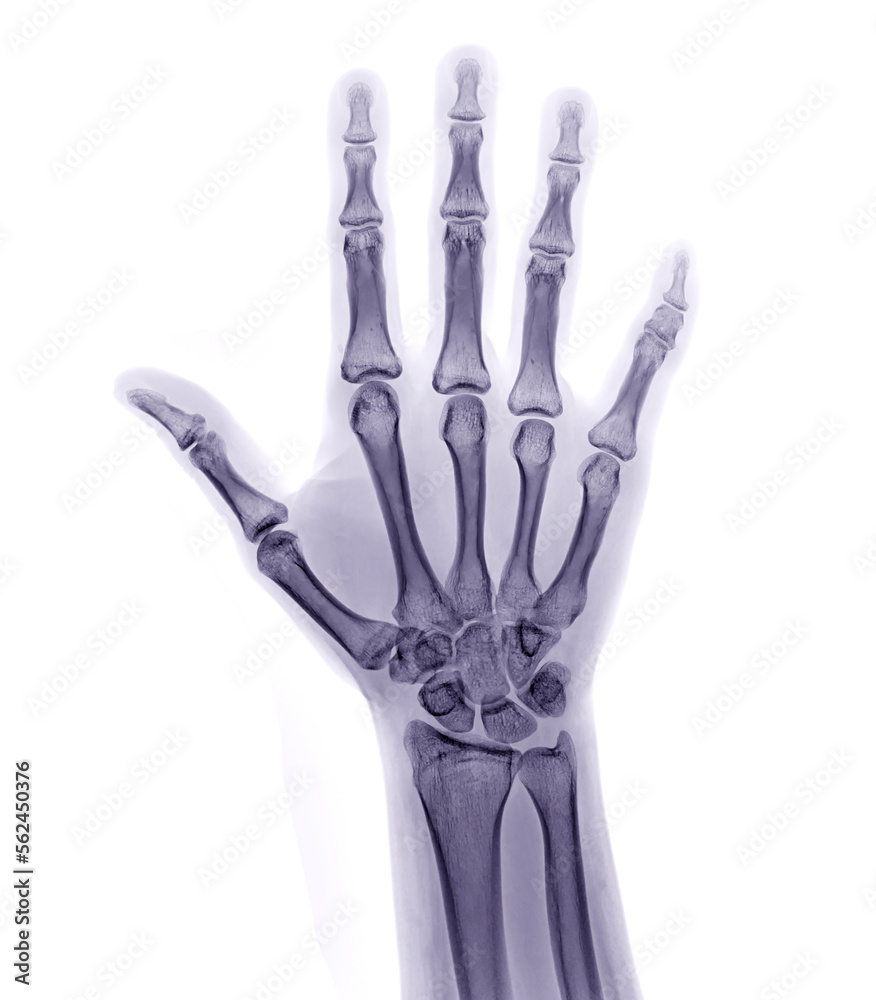 xray image of both hand AP view isolated on white background for ...