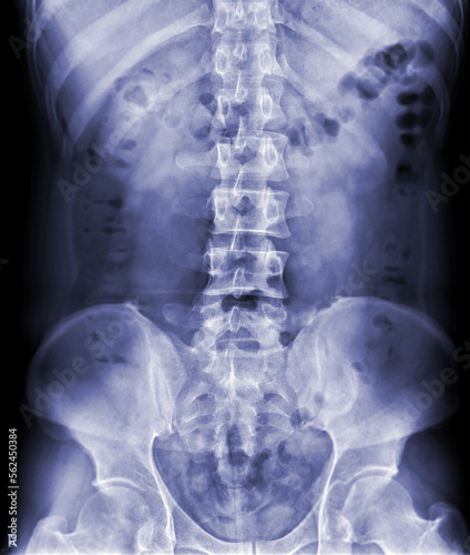 X-ray image of lambosacral spine or L-S spine