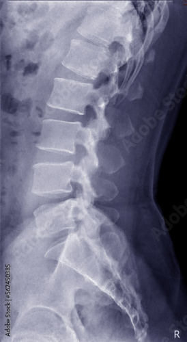 X-ray image of lambosacral spine or L-S spine