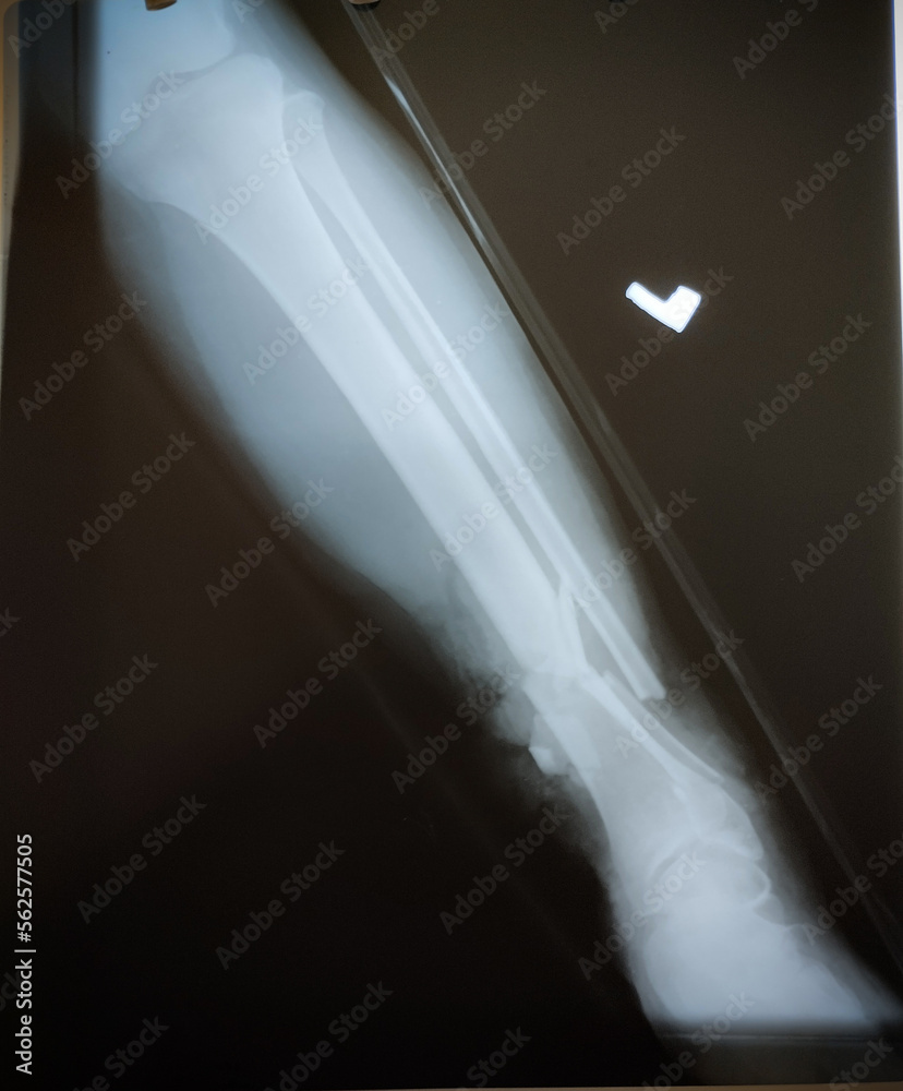 X Ray of adult female with radius ulna fracture Stock Photo | Adobe Stock
