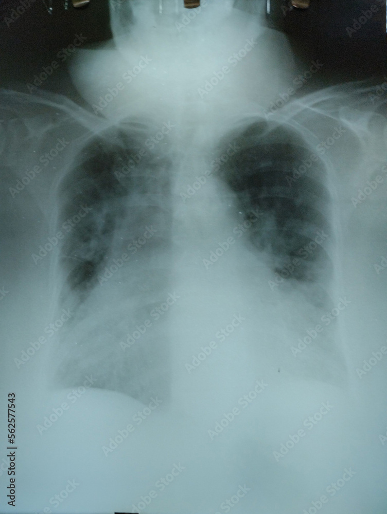 Chest X-ray of a patient with bilateral pleural effusion Stock Photo ...