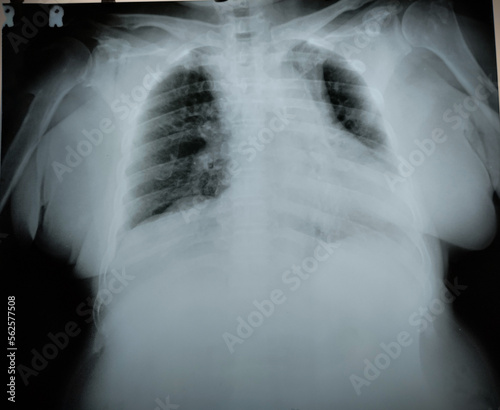 X Ray adult male with left pulmonary edema