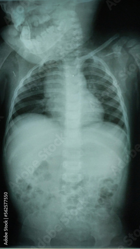 X Ray baby with an abnormal heart picture