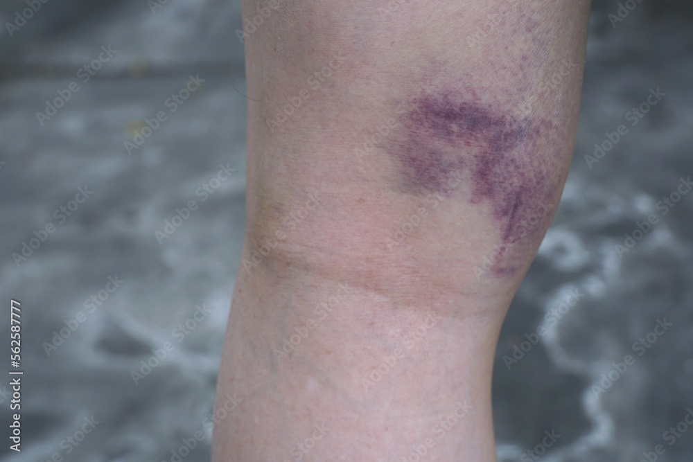 Bruise at back of the knee. Bruise at back of the knee.