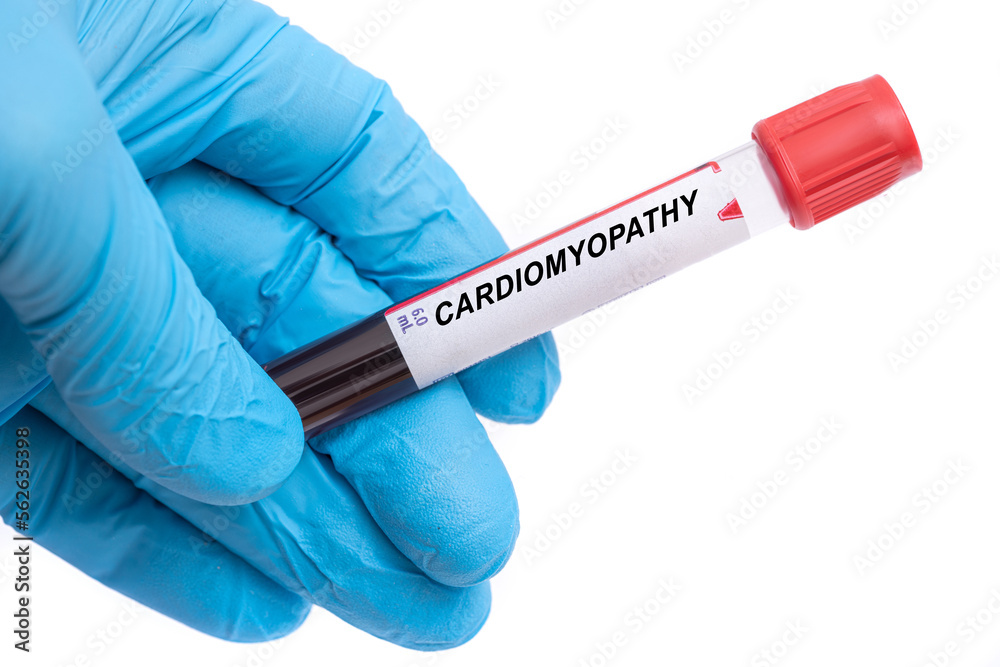 Obraz premium Cardiomyopathy. Cardiomyopathy disease blood test in doctor hand