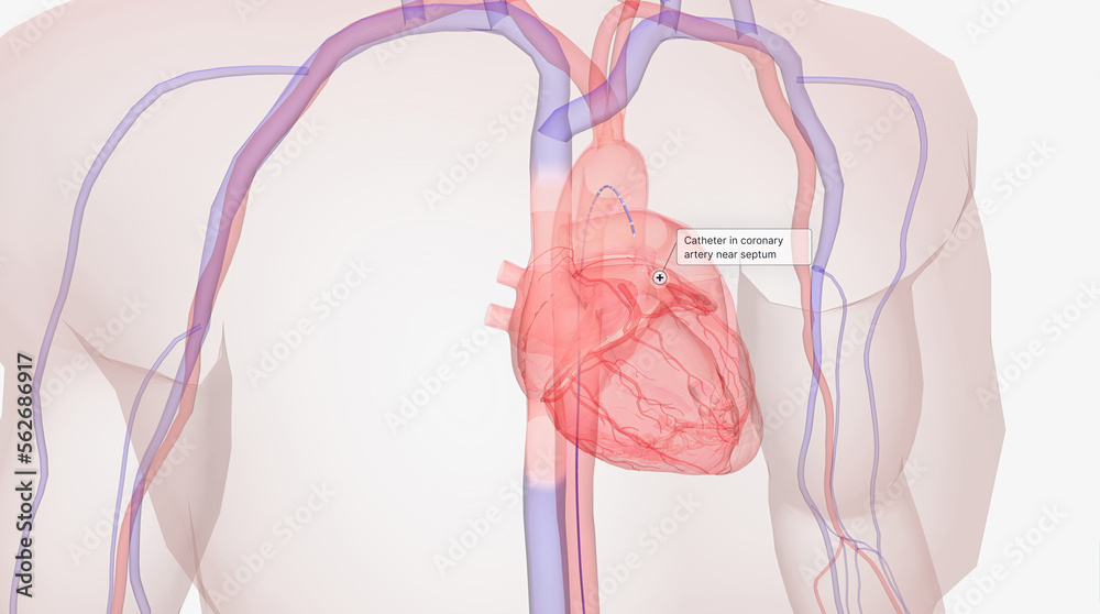 Using a local anesthetic, a catheter is inserted into a vein or artery