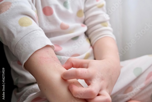 The child scratches atopic skin. Dermatitis, diathesis, allergy on the child's body.	
