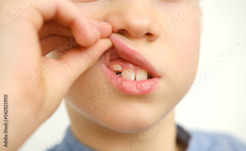 close-up hand of child, boy of 9 years old points new tooth fang in mouth with finger, concept of children's health, pediatric dentistry, dental correction of occlusion, treatment of crooked teeth photo