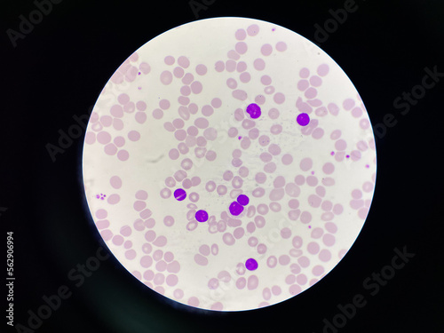 Chronic lymphocytic leukemia.