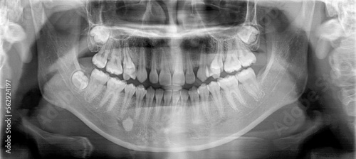 Film panoramic radiography view of the jaw.Multiple embedded and impaction teeth at both maxilla and mandible area.Panoramic dental and mandible x-ray image. photo