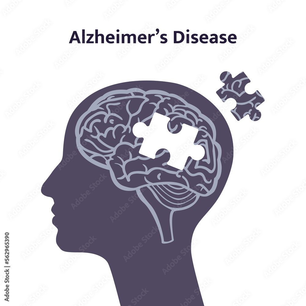 Alzheimer's disease vector illustration. Human brain lacking a piece of puzzle.