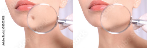 Collage with photos of patient's face before and after mole removing procedure, closeup. Dermatologist looking at skin through magnifying glass