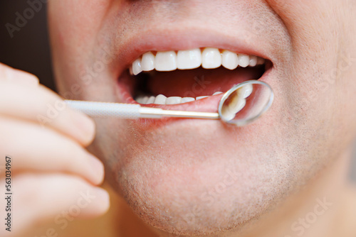 close-up. examination of teeth with veneers with a special dental mirror. the concept of dental and oral hygiene.