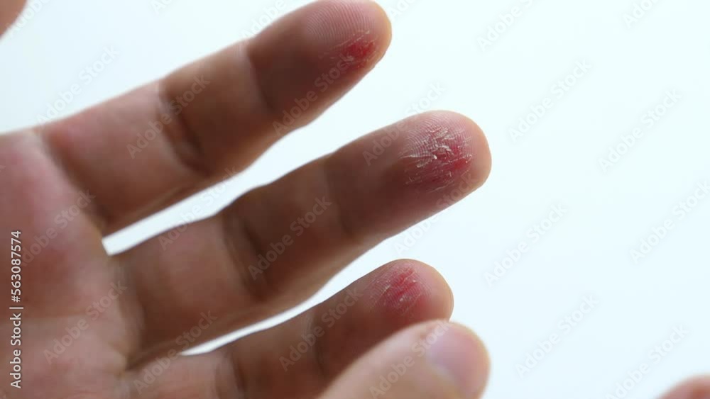 Closeup of man palm hand with injured fingers. Scratched skin bloody