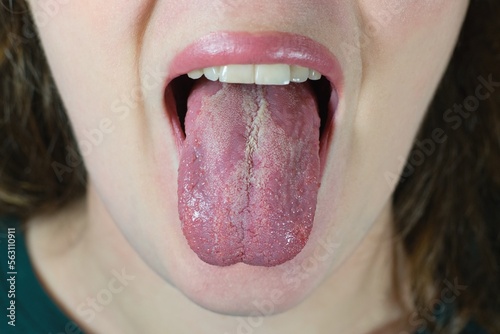 Oral Candidiasis or Oral trush (Candida albicans), yeast infection on the human tongue. photo