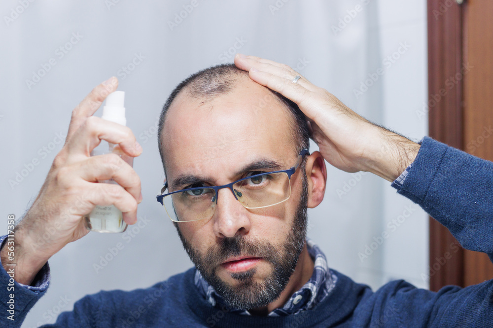 Obraz premium Young man with alopecia looking at his head and hair in the mirror and applying a spray medicine at home