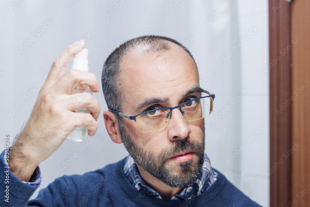 Obraz premium Young man with alopecia looking at his head and hair in the mirror and applying a spray medicine at home