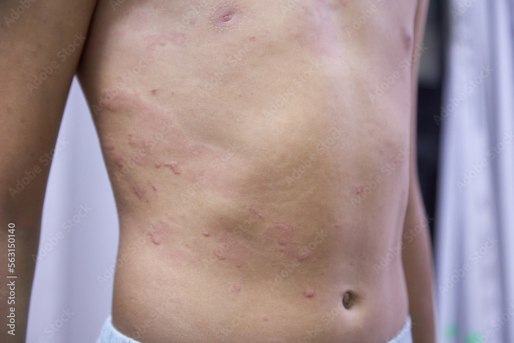 food allergy. a boy with red spots. The child has itching, with an allergic rash.. food allergy. a boy with red spots. The child has itching, with an allergic rash..