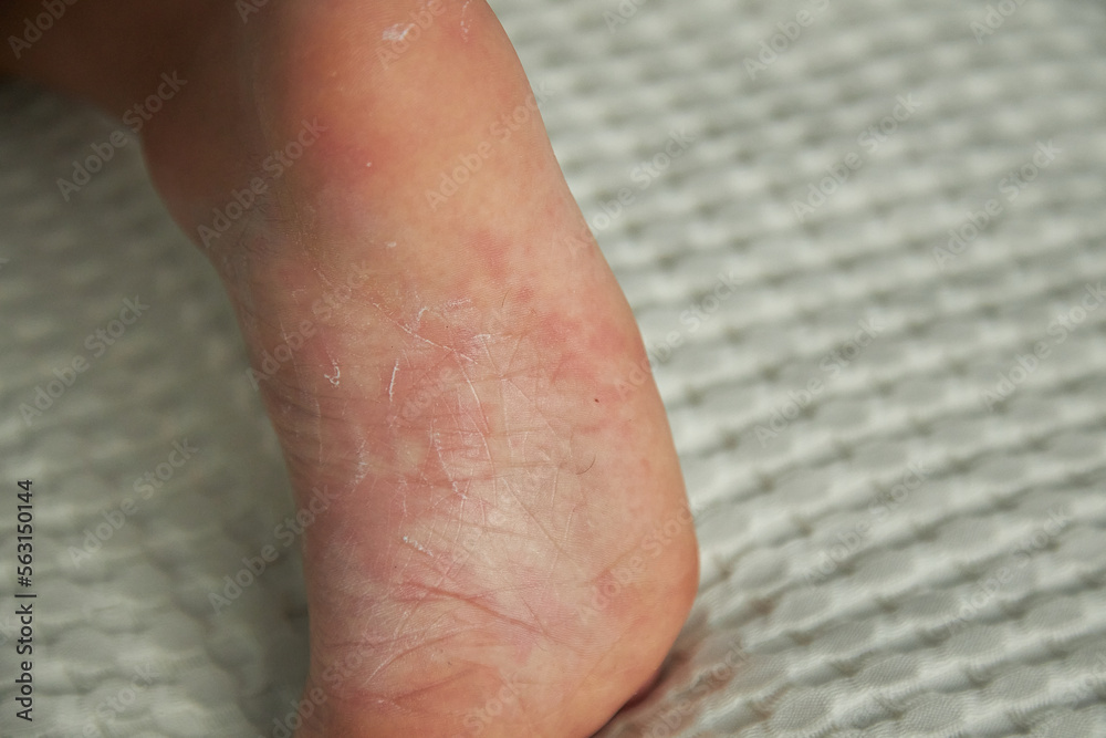 Fototapeta premium food allergy. a boy with red spots. The child has itching, with an allergic rash..