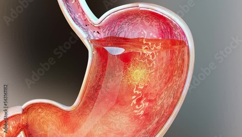 Stomach Acid Relux. Esophagus,  gerd. Pain In The Digestive System, Gastritis, pyrosis, human body organ, 3d render photo
