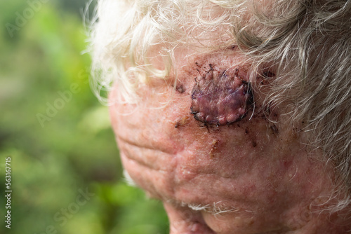 Surgery wound for excision of a BCC skin cancer with skin graft on the forehead of a senior male with sun damaged skin in Queensland, Australia.. photo