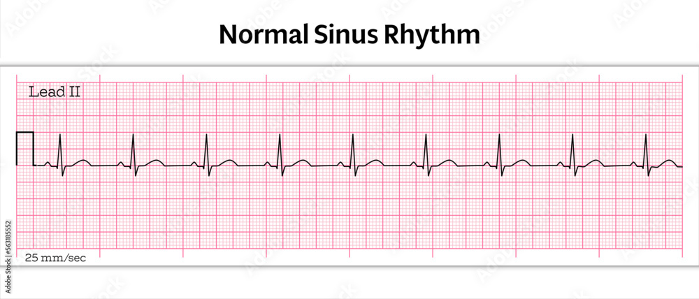 Poster ECG Normal Sinus Rhythm - 8 Second ECG Paper - Vector Medical ...
