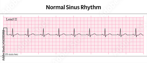 ECG Normal Sinus Rhythm - 8 Second ECG Paper - Vector Medical Illustration
