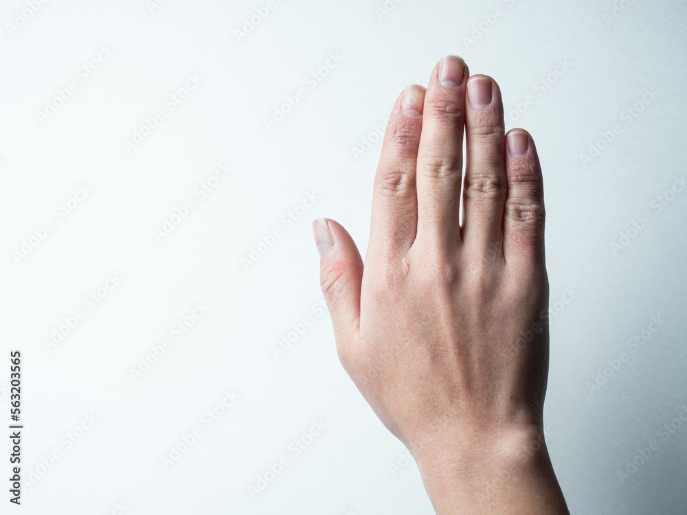 しもやけ・あかぎれ・凍傷で腫れた女性の手 しもやけ・あかぎれ・凍傷で腫れた女性の手