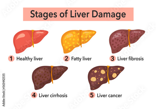 Stages of liver damage infographic concept vector illustration. Fatty liver, cirrhosis and liver cancer in flat design on white background. photo