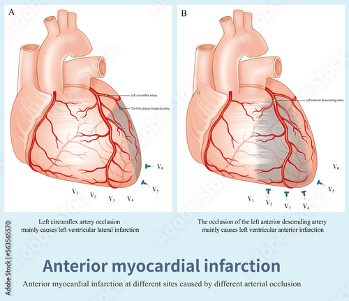 Left anterior descending artery occlusion causes left ventricular anterior infarction, and left circumflex artery occlusion causes lateral nfarction.The infarction range of the two is different. photo