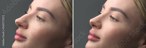 Nose Before and after plastic surgery. Rhinoplasty. Crooked nose correcting. Young woman profile portrait, over grey background. Beauty female, model girl face close-up. Aesthetic medicine photo