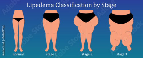 Lipedema classification by shape. Obesity illustration