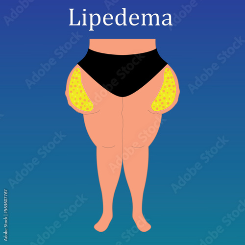 Foto Lipedema overweight female body. Fat cells illustration