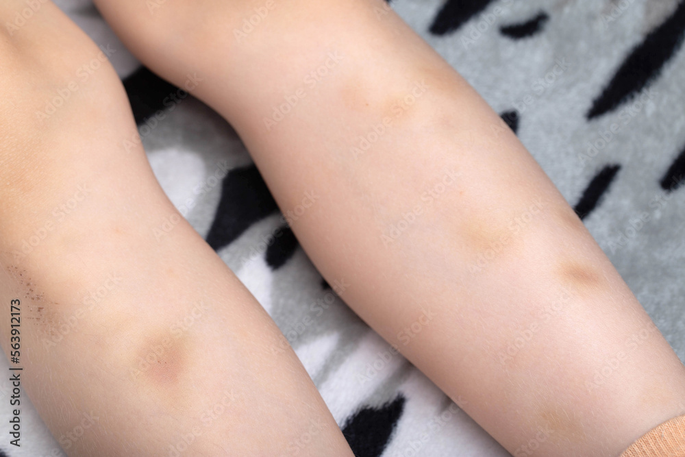 Spots, bruises on the legs of a child. The concept of injuries, lack of micro and macro elements, vitamins in the body.