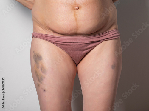 Bruises from injections on the girl's leg and a seam on her stomach from a caesarean section. The body of a woman after the birth of a child. Close-up