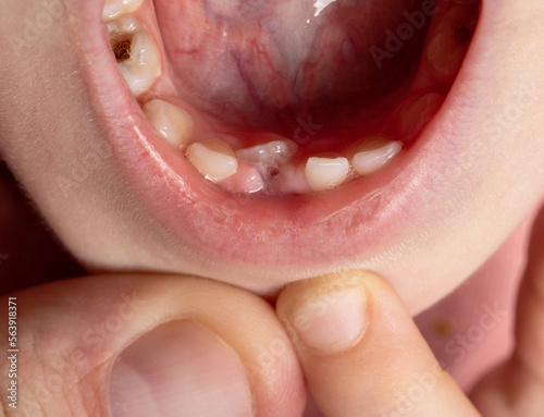 The child has a wrong tooth. Eruption of a permanent tooth in children, close-up
